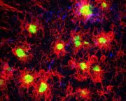 Felfedezték az összefüggést az Alzheimer-kór és az agyi immunsejtek között