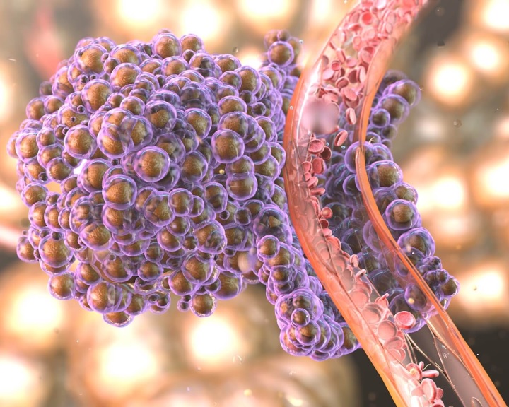 áttétes rákos sejtek ami emberi papillomavírus fertőzést jelent